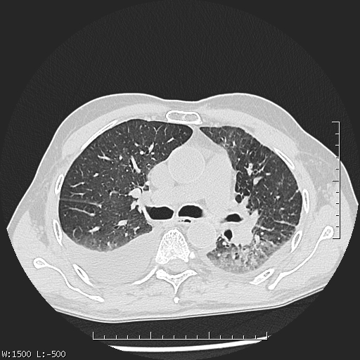 Aspergilloma (Radiopaedia 75184-86270 Axial lung window 21).jpg