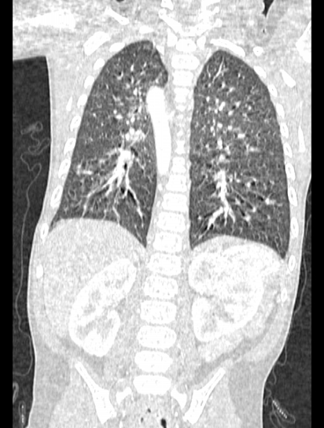 Asplenia syndrome (Radiopaedia 73083-83792 Coronal lung window 98).jpg