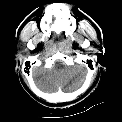 Atlanto-occipital dislocation (Radiopaedia 44648-48412 Axial non-contrast 10).jpg