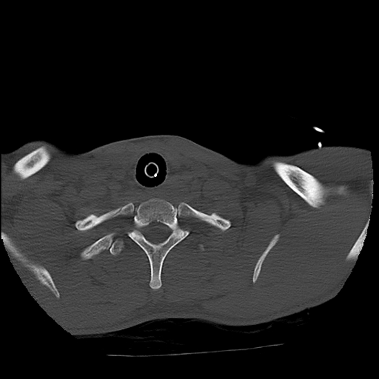 File:Atlanto-occipital dissociation (Traynelis type 1), C2 teardrop fracture, C6-7 facet joint dislocation (Radiopaedia 87655-104061 Axial bone window 86).jpg