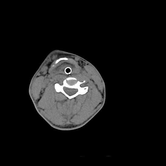 File:Atlanto-occipital dissociation (Traynelis type 1), C2 teardrop fracture, C6-7 facet joint dislocation (Radiopaedia 87655-104061 Axial non-contrast 49).jpg