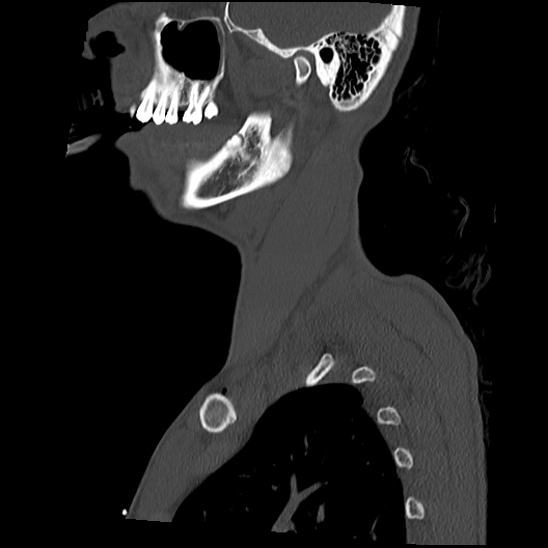 File:Atlanto-occipital dissociation (Traynelis type 1), C2 teardrop fracture, C6-7 facet joint dislocation (Radiopaedia 87655-104061 Sagittal bone window 10).jpg