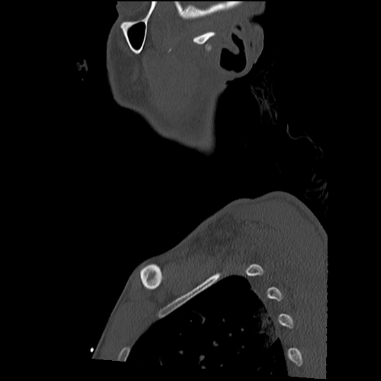 Atlanto-occipital dissociation (Traynelis type 1), C2 teardrop fracture, C6-7 facet joint dislocation (Radiopaedia 87655-104061 Sagittal bone window 2).jpg