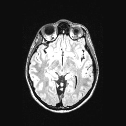 Atretic encephalocoele with inferior vermis hypoplasia (Radiopaedia 30443-31108 Axial 73).jpg