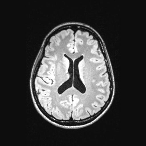 Atretic encephalocoele with inferior vermis hypoplasia (Radiopaedia 30443-31108 Axial 95).jpg