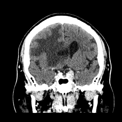 File:Atypical meningioma (WHO grade II) with brain invasion (Radiopaedia 57767-64728 Coronal C+ 27).png