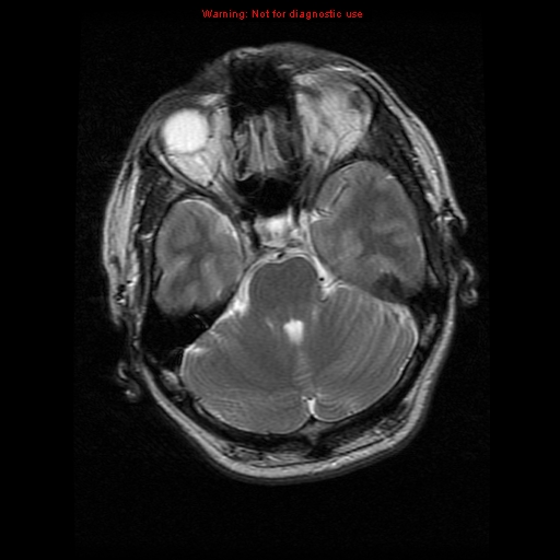 File:Atypical meningioma - grade II (Radiopaedia 13303-13305 Axial T2 7).jpg