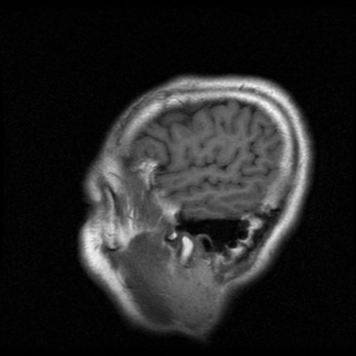 File:Atypical meningioma with skull invasion (Radiopaedia 34357-35648 Sagittal T1 20).png