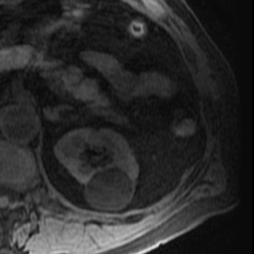 File:Atypical renal cyst on MRI (Radiopaedia 17349-17046 Axial T1 fat sat 10).jpg