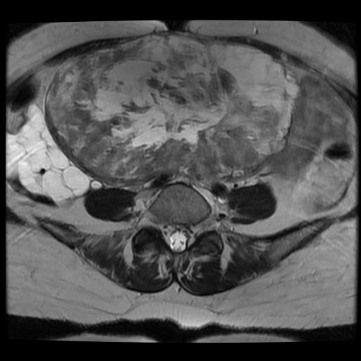 File:Atypical retroperitoneal lymphocoeles with large leiomyoma of uterus (Radiopaedia 32084-33027 Axial T2 9).jpg
