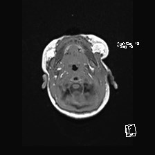 Atypical teratoid rhabdoid tumor (prenatal US and neonatal MRI) (Radiopaedia 59091-66388 Axial T1 7).jpg