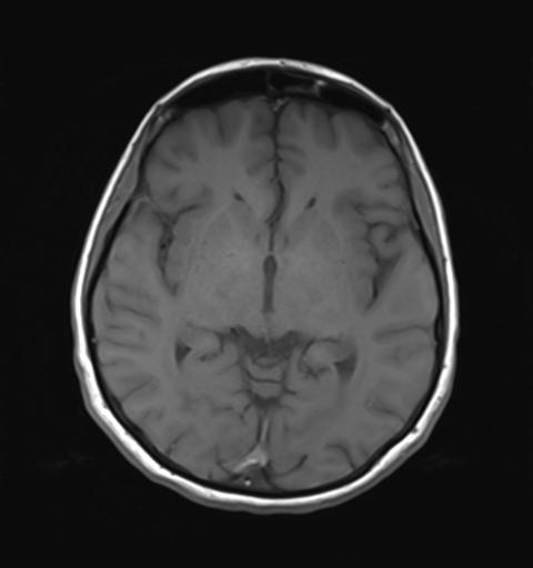 File:Autoimmune limbic encephalitis (Radiopaedia 30363-31005 Axial T1 16).jpg