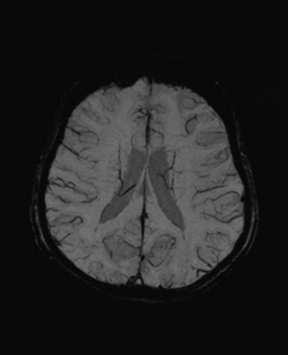 Autoimmune limbic encephalitis (Radiopaedia 30363-31005 SWI - mIP 47).jpg