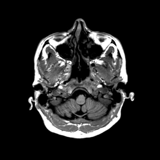 Autoimmune limbic encephalitis (Radiopaedia 30363-31005 T1 Axial 1mm 26).jpg