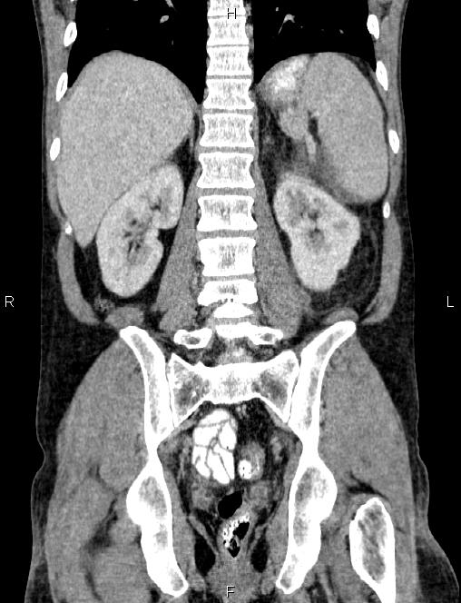 Autoimmune pancreatitis (Radiopaedia 84925-100431 D 43).jpg