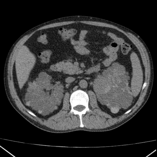 File:Autosomal dominant polycystic kidney disease (Radiopaedia 36539-38101 Axial non-contrast 34).jpg