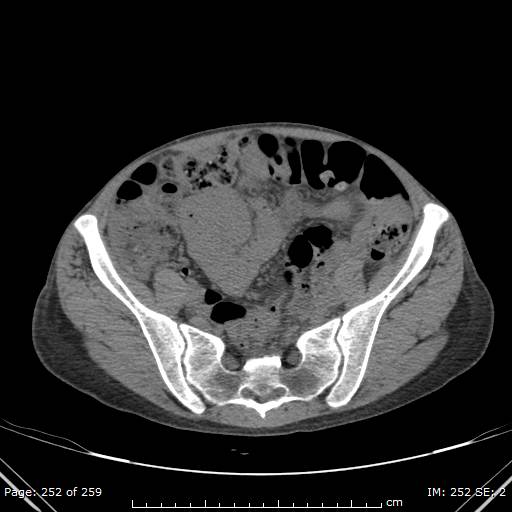 File:Autosomal dominant polycystic kidney disease (Radiopaedia 44122-47684 Axial 86).jpg