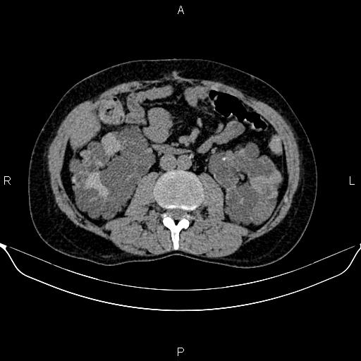 Autosomal dominant polycystic kidney disease (Radiopaedia 87830-104287 Axial non-contrast 28).jpg