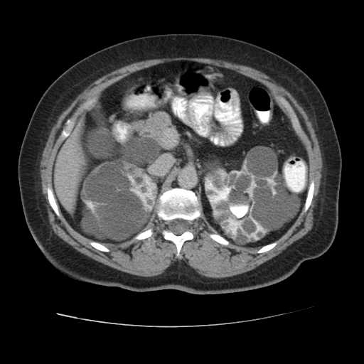 Autosomal dominant polycystic kidney disease with hepatic involvement (Radiopaedia 32693-33662 C 27).jpg