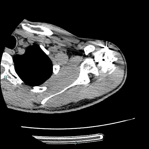 Avascular necrosis after fracture dislocations of the proximal humerus (Radiopaedia 88078-104655 D 41).jpg