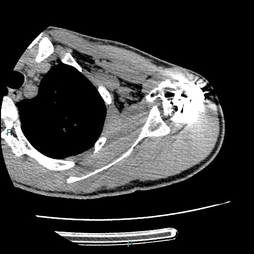 Avascular necrosis after fracture dislocations of the proximal humerus (Radiopaedia 88078-104655 D 51).jpg