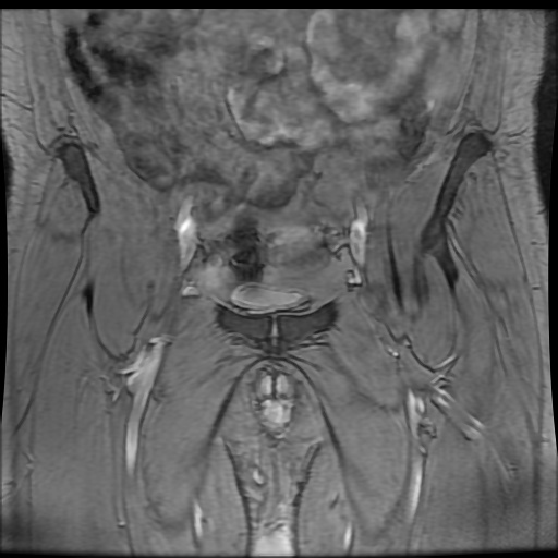 Avascular necrosis of the hip (Radiopaedia 61503-69465 F 13).jpg