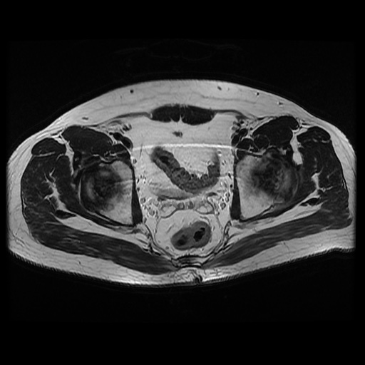File:Avascular necrosis of the hip (Radiopaedia 61503-69465 T2 14).jpg