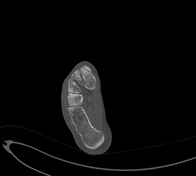 Avulsion fractures of talus and calcaneus (Radiopaedia 48277-53155 Axial bone window 94).jpg