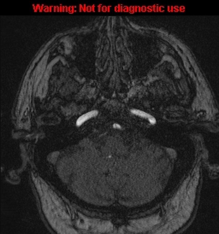Azygos anterior cerebral artery (Radiopaedia 59325-66677 Axial MRA 26).jpg