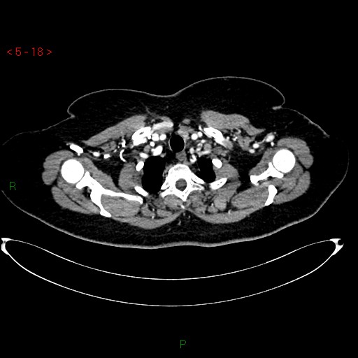 Azygos fissure and lobe (Radiopaedia 47620-52278 A 4).jpg