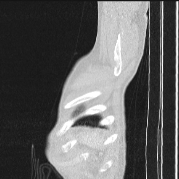 Azygos lobe (Radiopaedia 38259-40275 lung window 96).jpg
