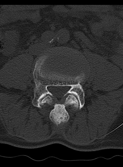 File:Baastrup syndrome (Radiopaedia 64891-73838 Axial bone window 5).jpg