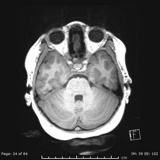 File:Balo concentric sclerosis (Radiopaedia 61637-69636 Axial T1 24).jpg