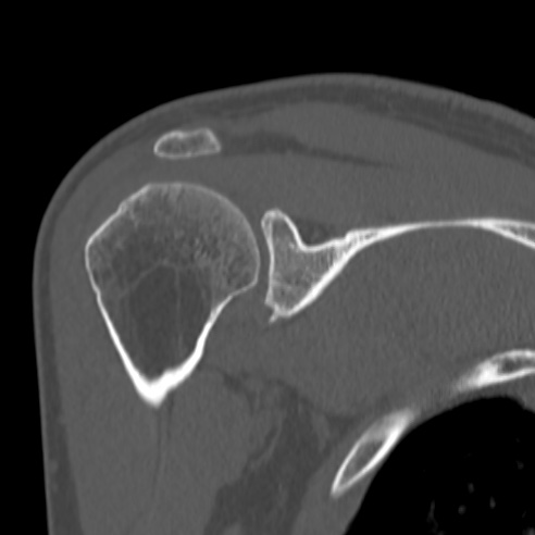 Bankart lesion (Radiopaedia 57256-64185 Coronal bone window 25).jpg