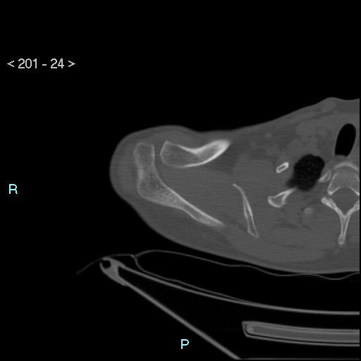 Bankart lesion with glenoid bone defect - assessment TC with PICO method (Radiopaedia 42855-93901 Axial bone window 23).jpg