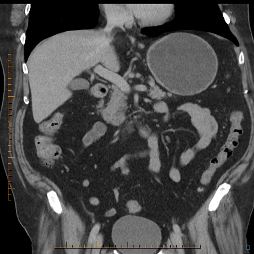 File:Bariatric balloon causing gastric outlet obstruction (Radiopaedia 54449-60672 B 27).jpg