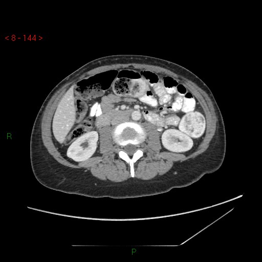 Bartholin gland cyst (Radiopaedia 54904-61181 A 36).jpg