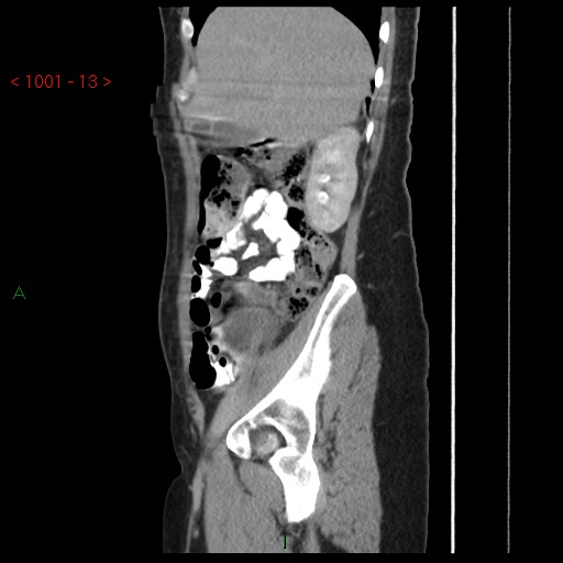 File:Bartholin gland cyst (Radiopaedia 54904-61181 Sagittal C+ delayed 13).jpg