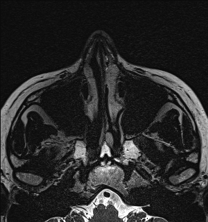 Basal cell carcinoma - nasal region (Radiopaedia 70292-80365 Axial Gradient Echo 19).jpg