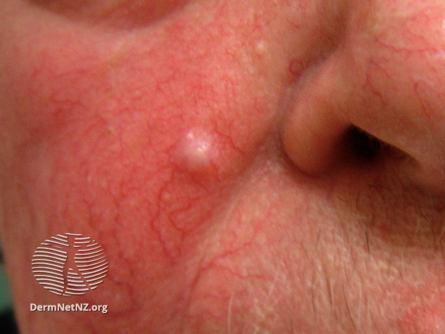 File:Basal cell carcinoma affecting the face (DermNet NZ lesions-bcc-face-1098).jpg