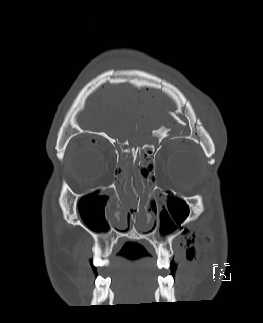 Base of skull fracture with bilateral Le Fort fractures (Radiopaedia 47094-51638 Coronal bone window 80).jpg