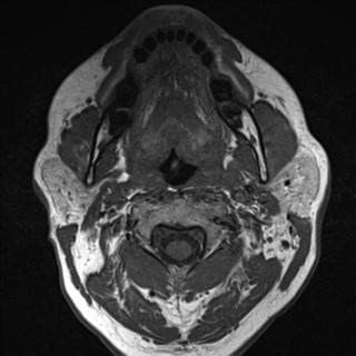 File:Base of tongue squamous cell carcinoma (Radiopaedia 31174-31884 Axial T1 23).jpg
