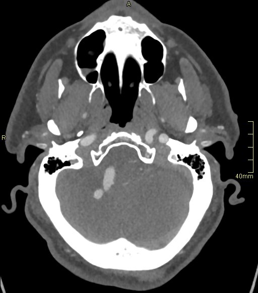 Basilar artery aneurysm (Radiopaedia 56261-62932 A 45).jpg