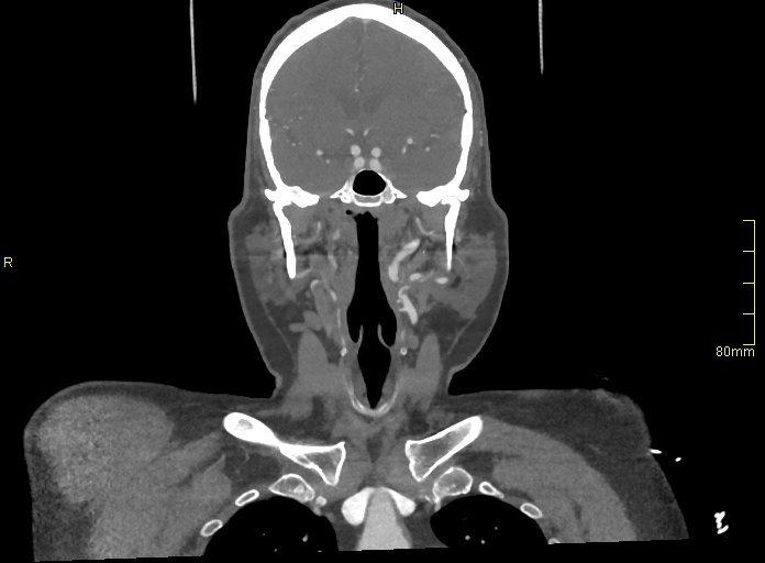 Basilar artery aneurysm (Radiopaedia 56261-62932 B 11).jpg