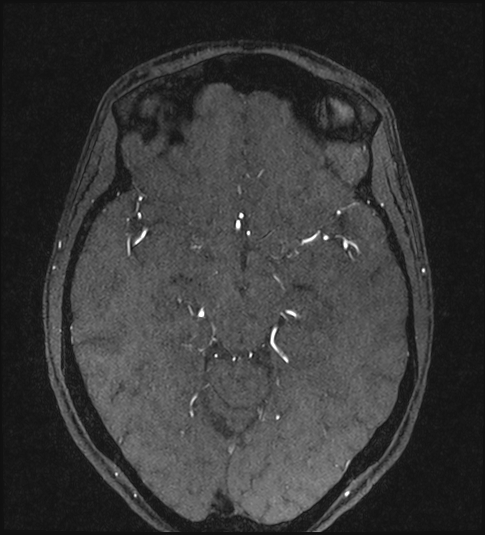 Basilar artery perforator aneurysm (Radiopaedia 82455-97733 Axial MRA 112).jpg