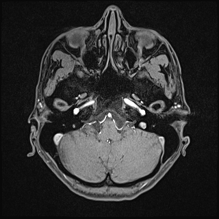 Basilar artery perforator aneurysm (Radiopaedia 82455-97733 Axial T1 fat sat 27).jpg
