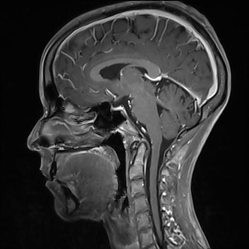 File:Basilar artery perforator aneurysm (Radiopaedia 82455-97733 G 73).jpg