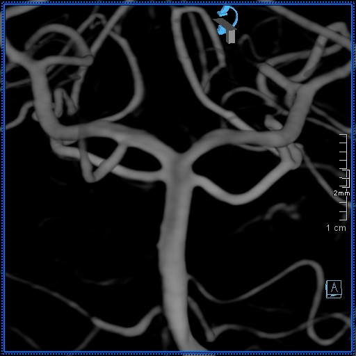 Basilar artery perforator aneurysm (Radiopaedia 82455-99524 3D Left VA 44).jpg