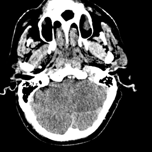 Basilar artery thrombosis (Radiopaedia 53351-59333 Axial non-contrast 34).jpg