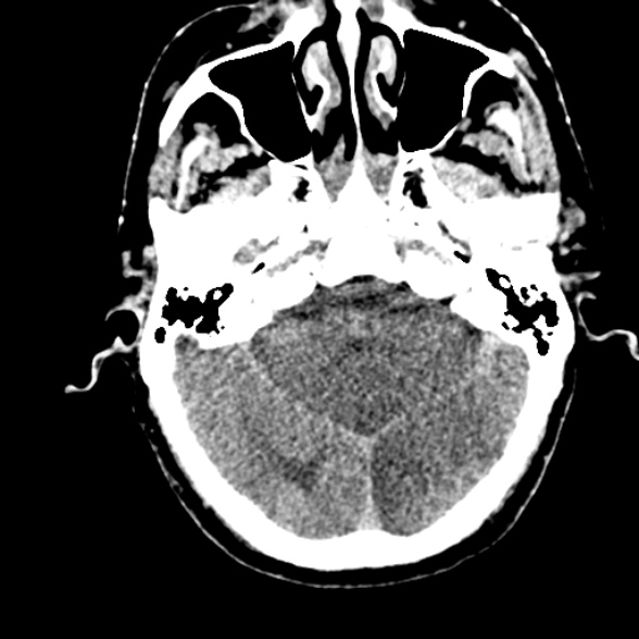Basilar artery thrombosis (Radiopaedia 53351-59352 Axial non-contrast 38).jpg